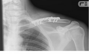 milway shoulder